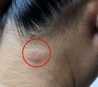 Topical Medications