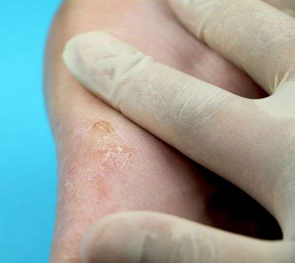 Why choose SkinQure for Tinea