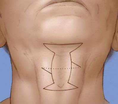 Submentoplasty