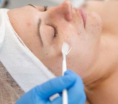 Chemical Peels