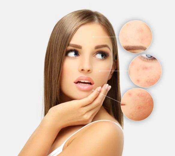 Why choose SkinQure for Acne Page Demo