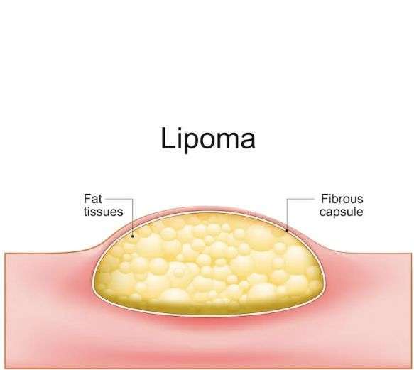 Lipoma Treatment In South Delhi Saket Skinqure