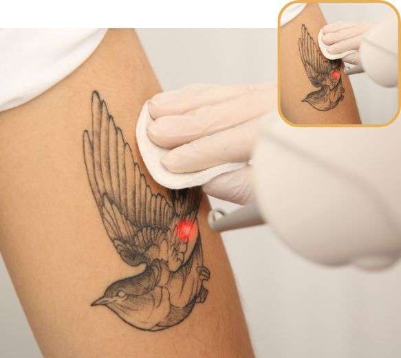 Why choose SkinQure for Tattoo Removal
