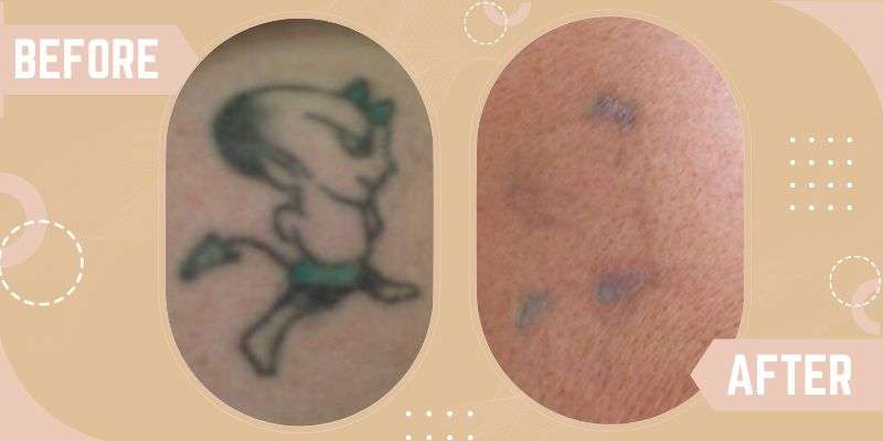Tattoo Removal before and after result at SkinQure