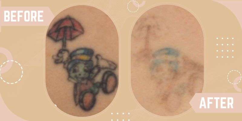 Tattoo Removal before and after result at SkinQure