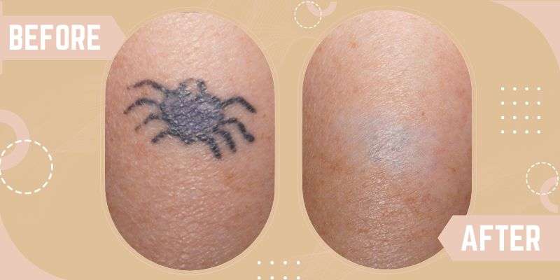 Tattoo Removal before and after result at SkinQure