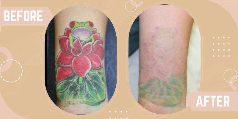Tattoo Removal before and after result at SkinQure