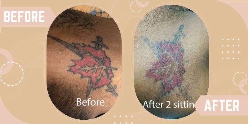 Tattoo Removal before and after result at SkinQure
