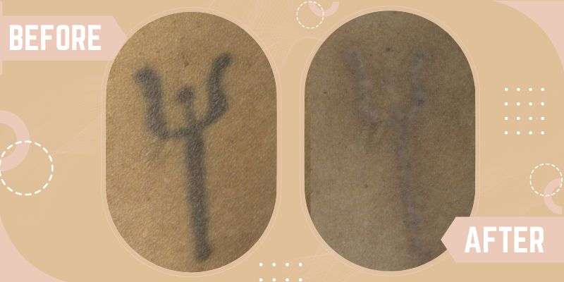 Tattoo Removal before and after result at SkinQure