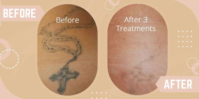 Tattoo Removal before and after result at SkinQure