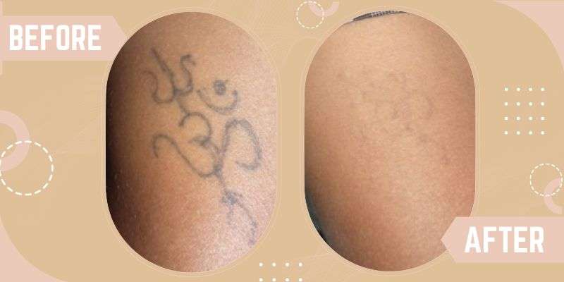 Tattoo Removal before and after result at SkinQure