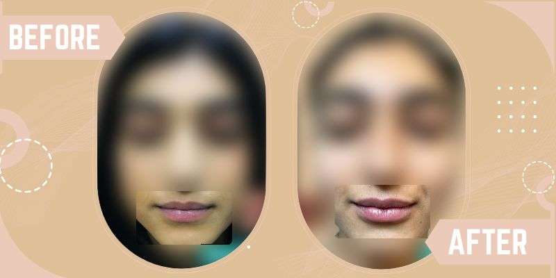 Lip Enhancement before and after result at SkinQure