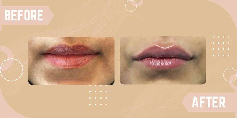 Lip Enhancement before and after result at SkinQure