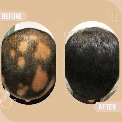 Alopecia Areata