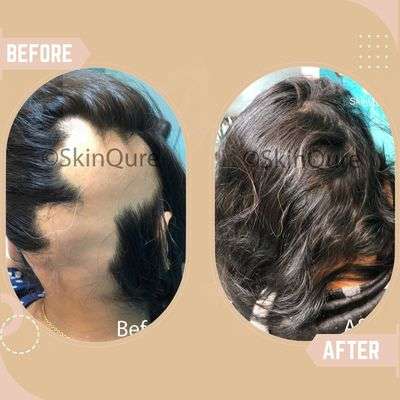 Alopecia Areata 2