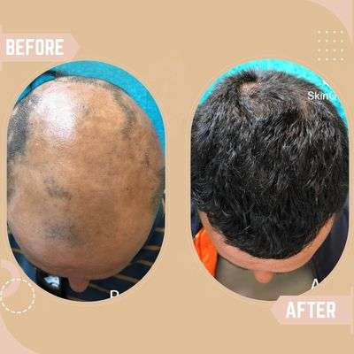 Alopecia Areata 3