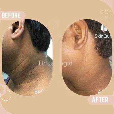 Neck Pigmentation 2