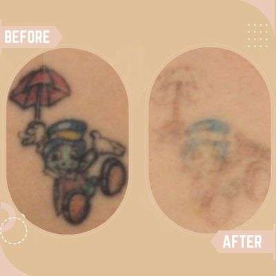 Tattoo Removal