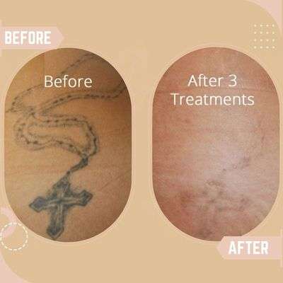 Tattoo Removal 7