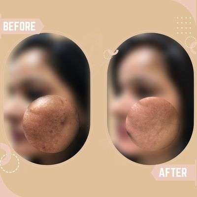 Melasma Archana