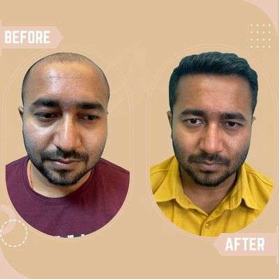 Hair Transplant results