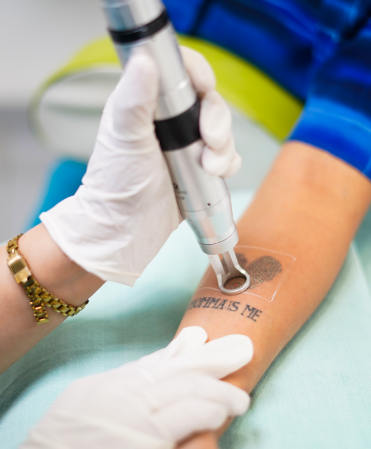 Laser Tattoo Removal