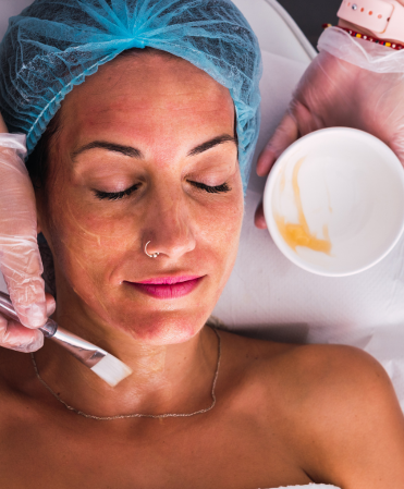 Chemical Peels