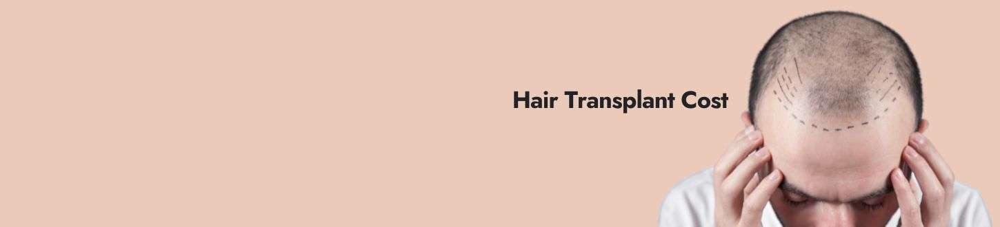 Understanding Hair Transplant Cost in Delhi - What You Need to Know