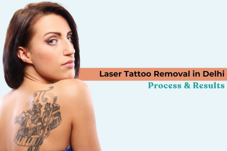  Laser Tattoo Removal in Delhi: Process & Results