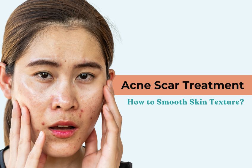 Acne Scar Treatment: How to Smooth Skin Texture?