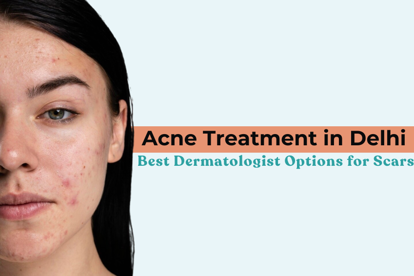 Acne Treatment in Delhi: Best Dermatologist Options for Scars