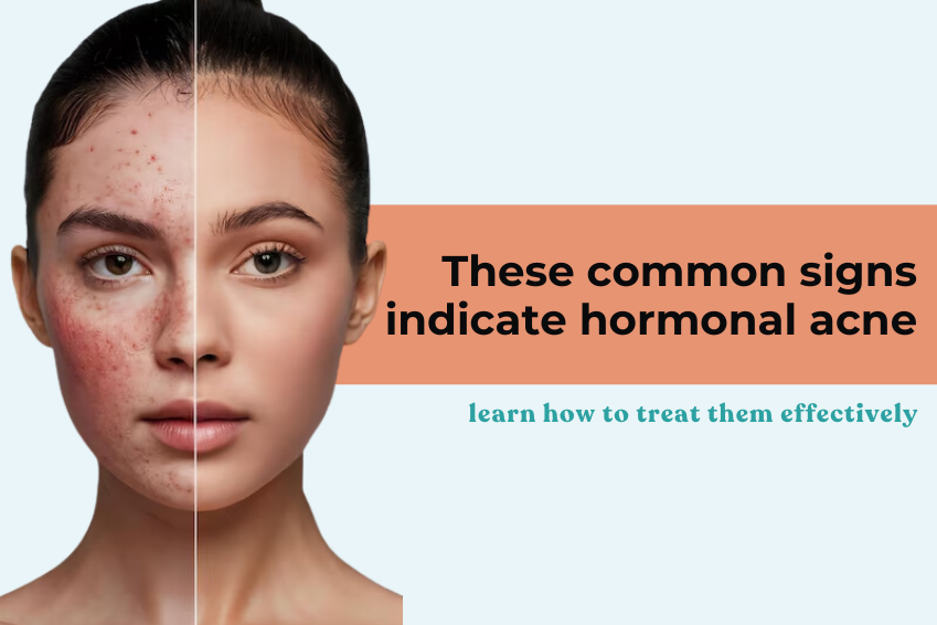 These common signs indicate hormonal acne- learn how to treat them effectively