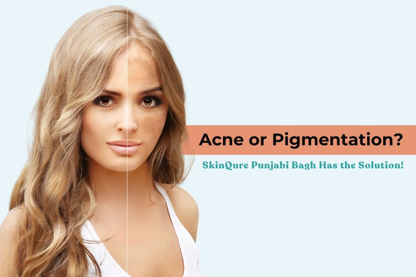 Acne or Pigmentation? SkinQure Punjabi Bagh Has the Solution!