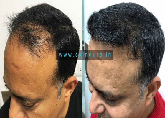 Best Hair Transplant Clinic in Delhi
