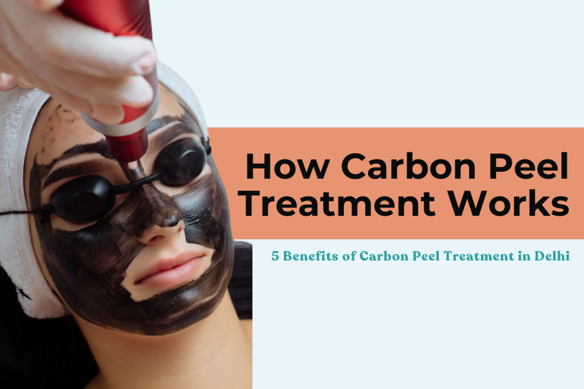 How Carbon Peel Treatment Works: 5 Benefits of Carbon Peel Treatment in Delhi