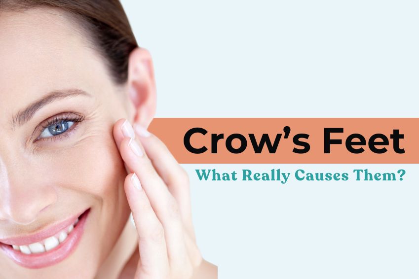 Crow’s Feet: What Really Causes Them?