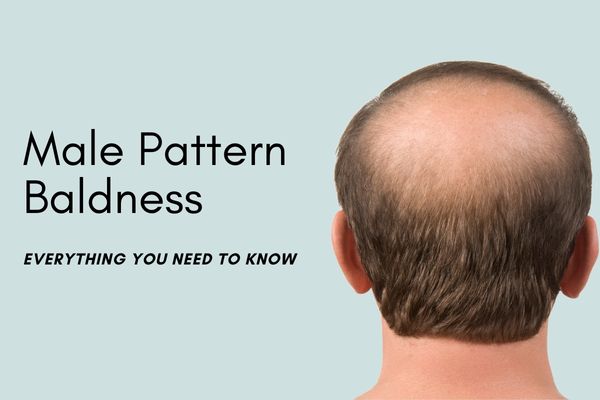 Male Pattern Baldness: Causes, Identification, and Prevention
