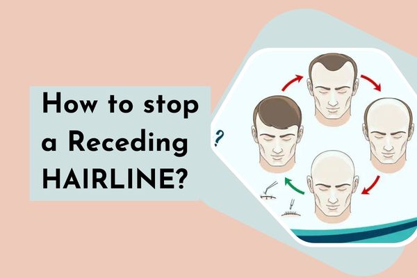 How to Stop a Receding Hairline: The Best Treatment Options