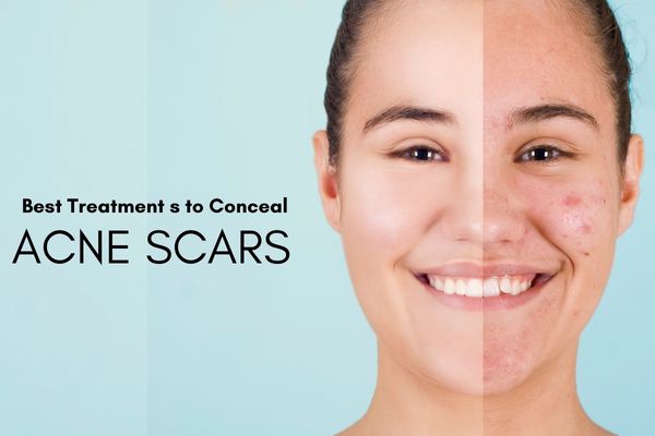 Best Treatments to Conceal Acne Scars