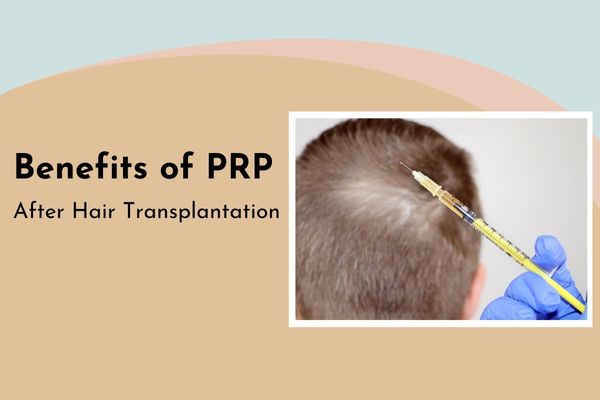 Advantages of PRP After Hair Transplant