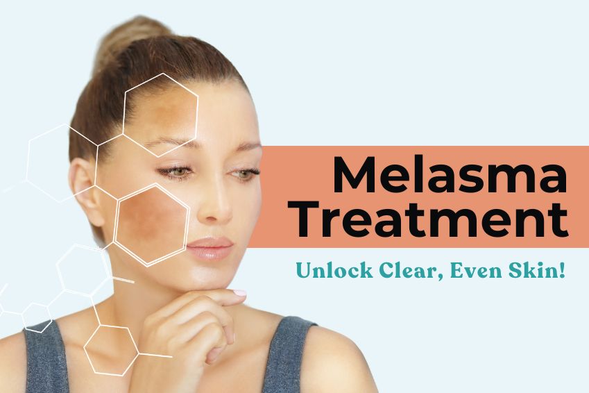 Melasma Treatment: Unlock Clear, Even Skin