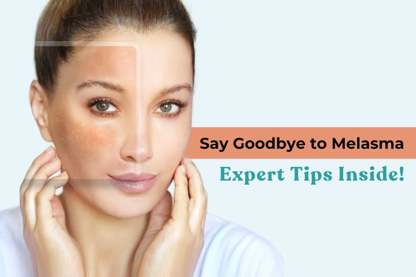 Say Goodbye to Melasma: Expert Tips Inside!