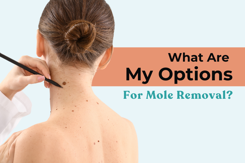 What Are My Options For Mole Removal?