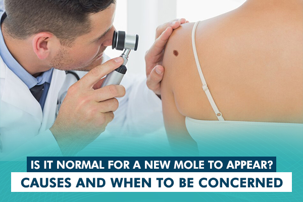 Is it Normal for New Moles to Appear? Causes and Concerns