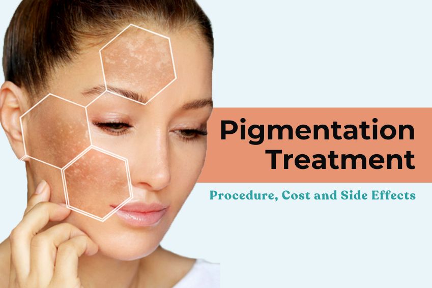 Skin Pigmentation Treatment: Procedure, Cost and Side Effects