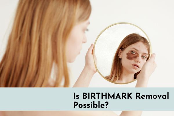 Everything You Need to Know About Birthmarks