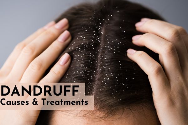 What is dandruff? Its cause, symptoms and treatment options