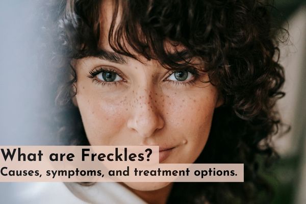 What are freckles? Causes, symptoms and treatment options