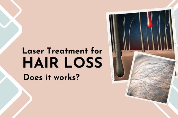 Laser Treatment for Hair Loss: Does It Work?