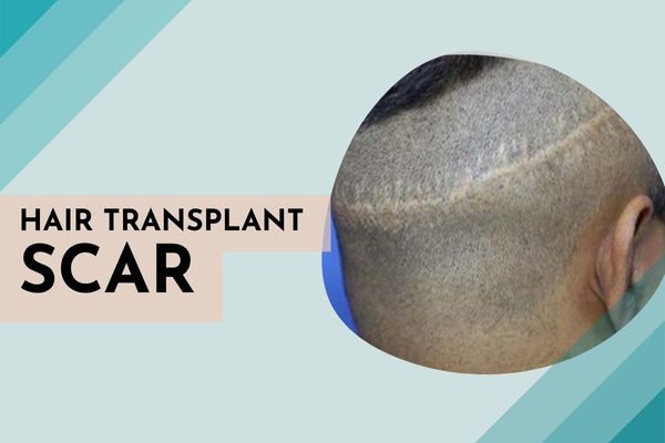 Get Rid of Melasma Pigmentation at SkinQure – Know the Causes, Treatment and Results